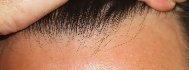 Comment devrait être la ligne naturelle des cheveux dans une greffe de cheveux ? La réponse est dans l'image.