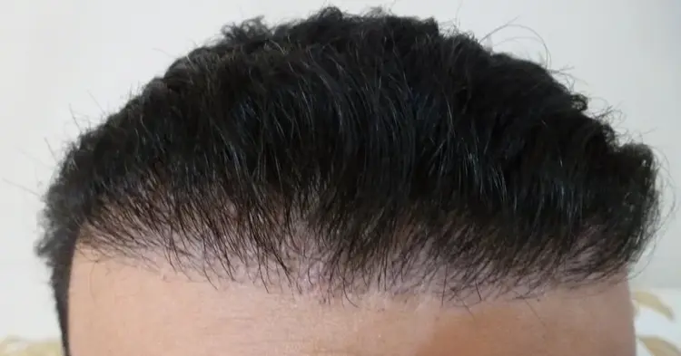 Uma linha de cabelo terrível e ruim que se forma após um transplante capilar.