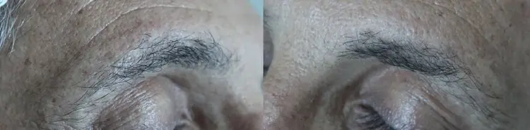 Transplante de pelos da sobrancelha para cicatriz