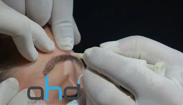 O método DHI de transplante capilar de sobrancelhas permite resultados com aparência natural.