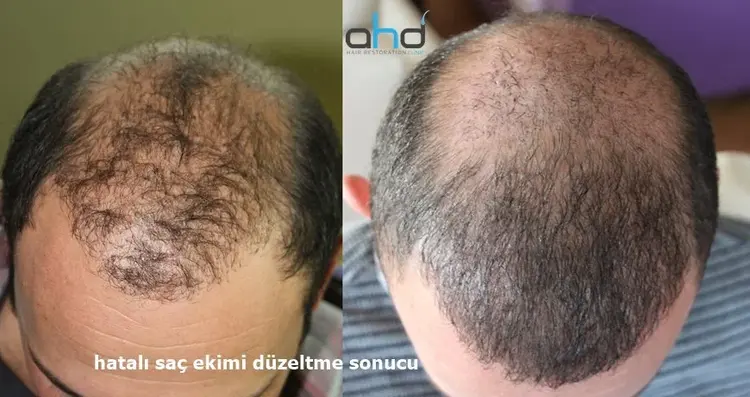 hatalı saç ekimini düzeltme sonucu