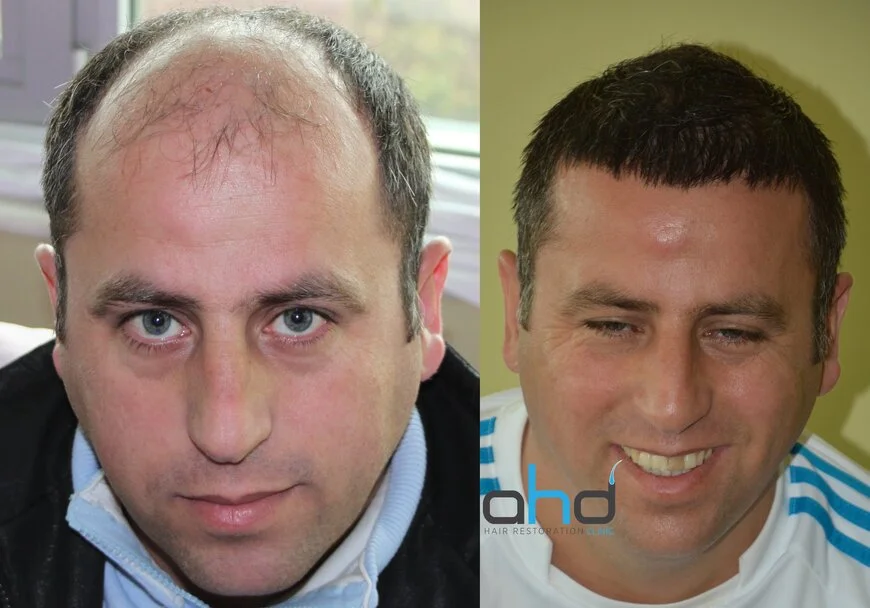 natural hair transplant result