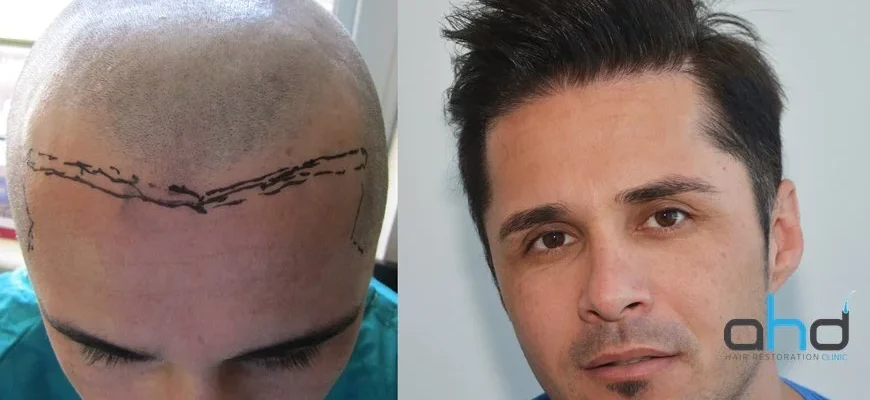 natural hair transplant