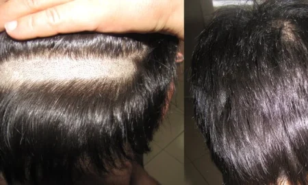 no shave hair transplant
