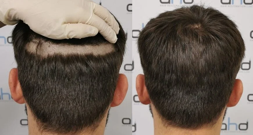 non shaven hair transplant