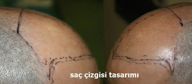 saç çizgisi oluşturma
