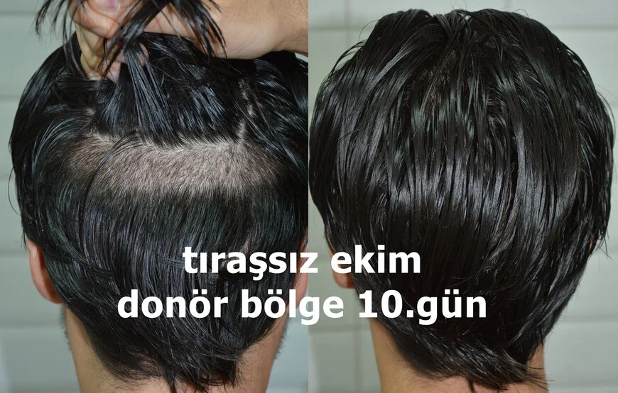 Tıraşsız Saç Ekimi - Ağrısız Saç Ekimi - Este Sağlık Tıraşsız Saç Ekimi - Ağrısız Saç Ekimi - Este Sağlık