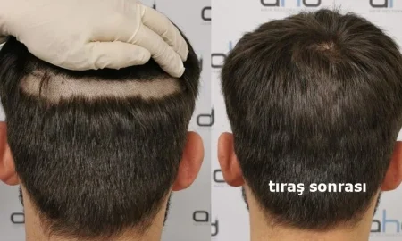 tıraşsız saç ekimi