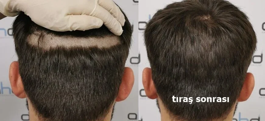 tıraşsız saç ekimi