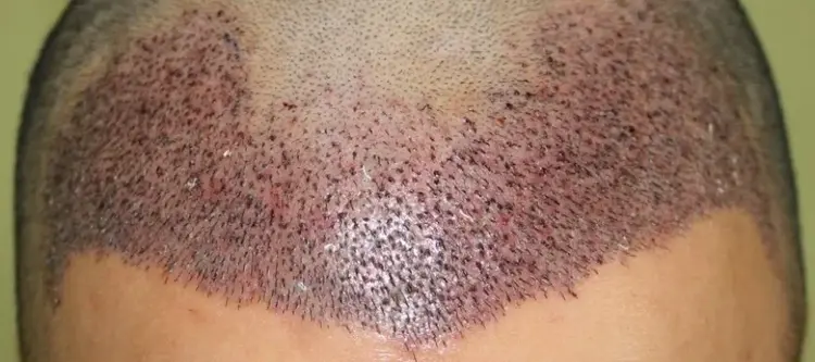 tranplante de cabello