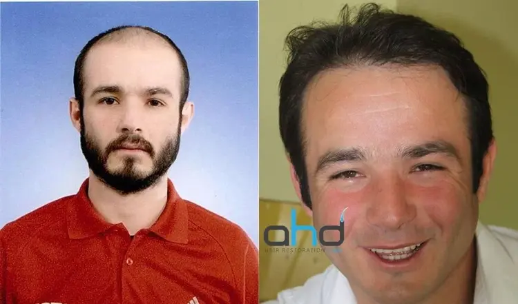 Um recuo natural do cabelo e um resultado perfeito de transplante capilar.