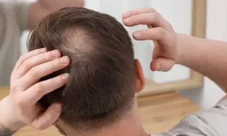 transplante capilar coroa da cabeça