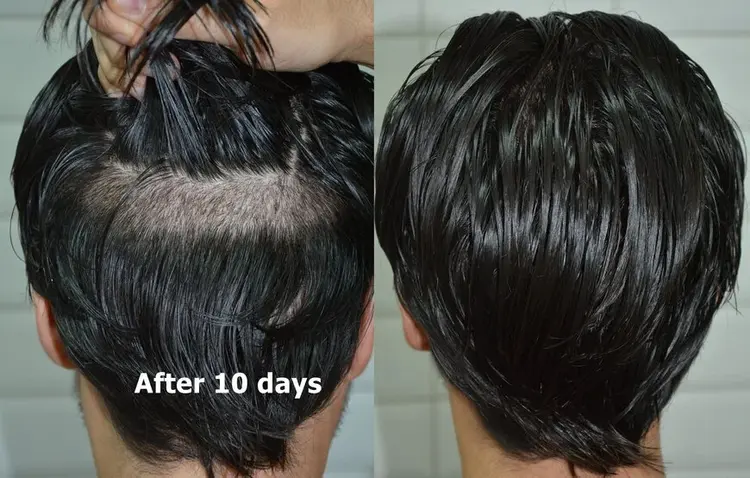 transplante capilar sem raspar e 10 dias depois