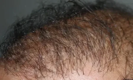 transplante capilar que deram errado