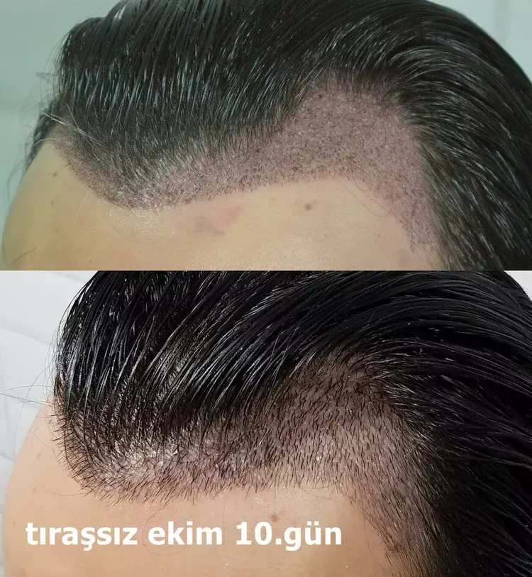 Em um transplante capilar Norwood 3, o cabelo não foi totalmente raspado.