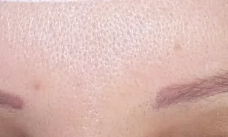 transplante de sobrancelha