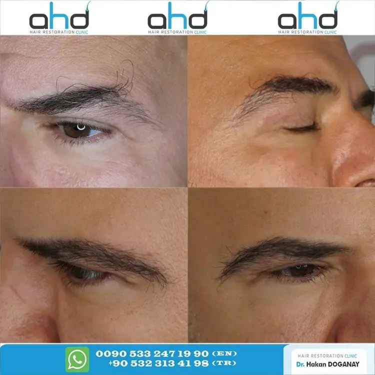 transplante de sobrancelha antes e depois