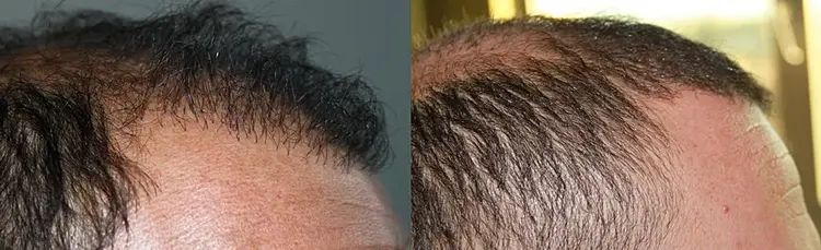 "Como reparar uma linha de cabelo ruim