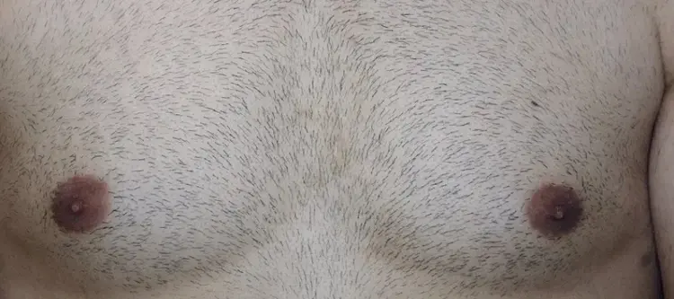 trapianto capelli con peli corporei