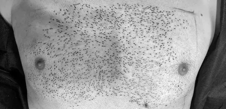 trapianto capelli da peli petto