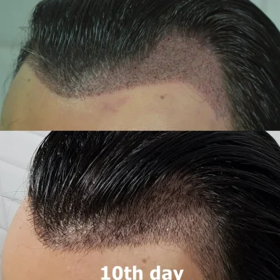 after 10 days unshaven hair transplant