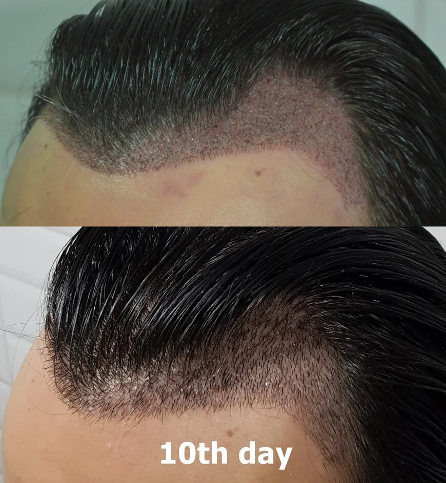 after 10 days unshaven hair transplant