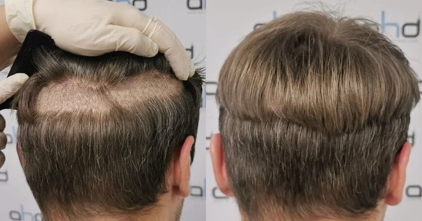 unshaven hair transplant