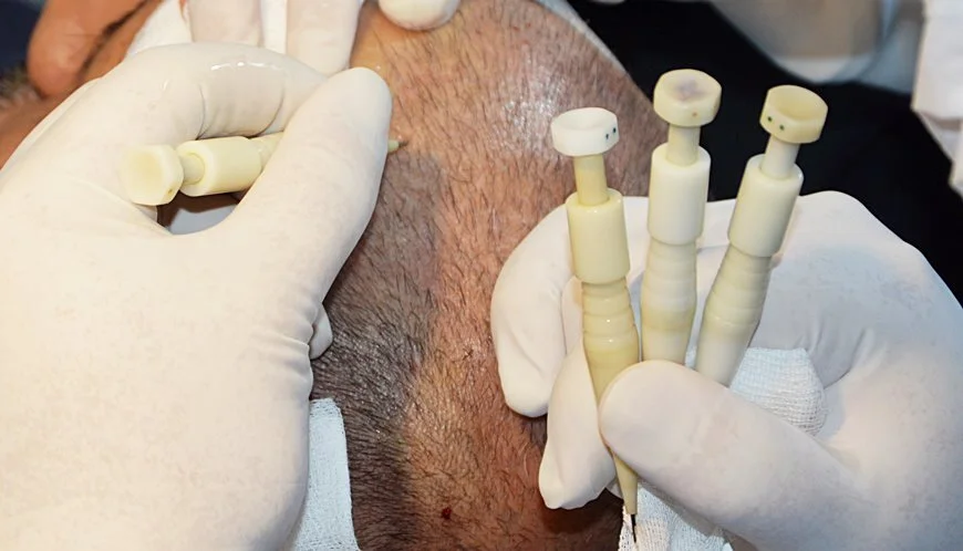 what is dhi hair transplant