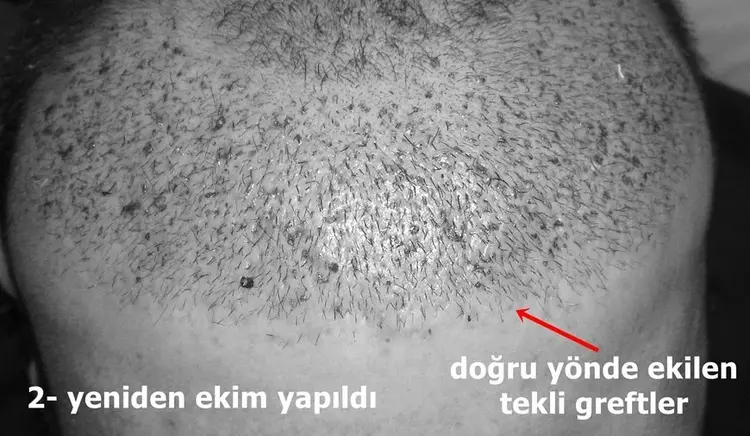 yanlış yapılan saç ekiminde saç yönlerini düzeltme işlemi