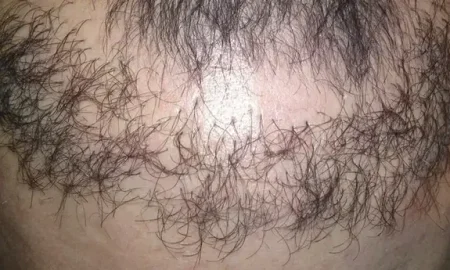 Неудачный и очень плохой пример пересадки волос