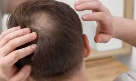 пересадка_волос-на_макушку