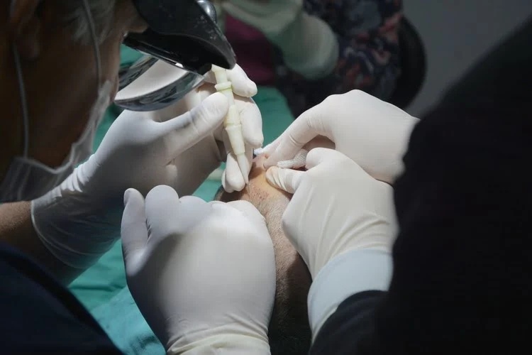 كيفية زراعة الشعر بتقنية القلم