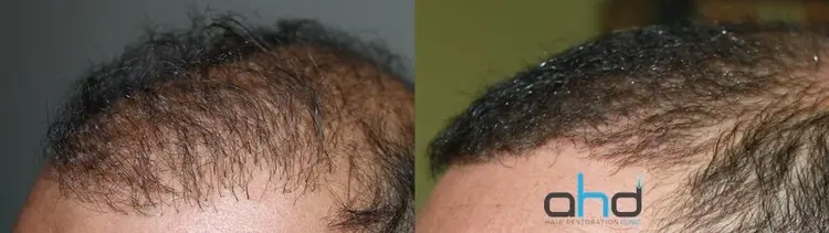 زراعة الشعر إصلاح