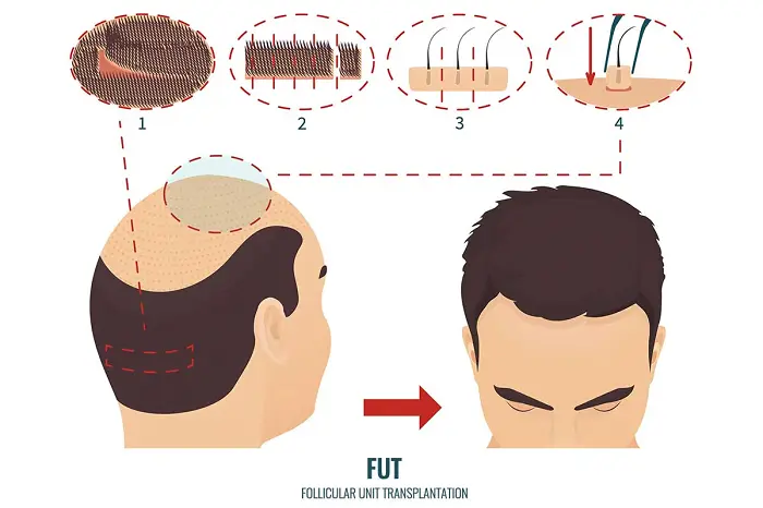 زراعة الشعر بتقنية FUT