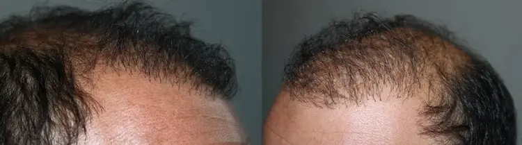 زراعة شعر فاشلة: زوايا خاطئة وطعمات متعددة في خط الشعر ومظهر خفيف