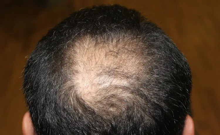 زراعة الشعر لمنطقة التاج نسبة النجاح