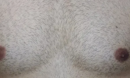 زراعة الشعر من شعر الجسم