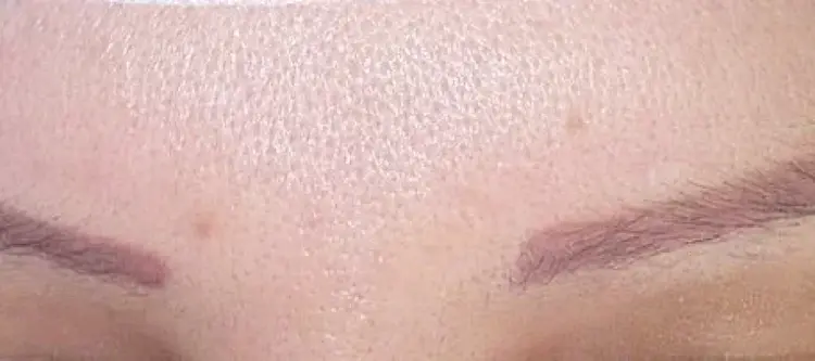 زراعة شعر الحواجب