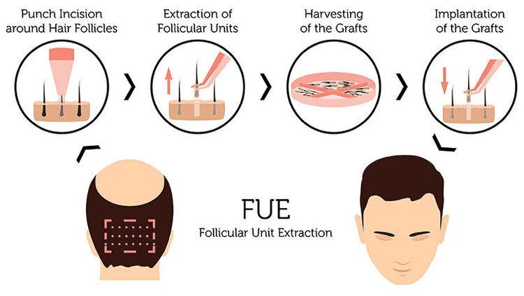 زراعة الشعر بتقنية fue
