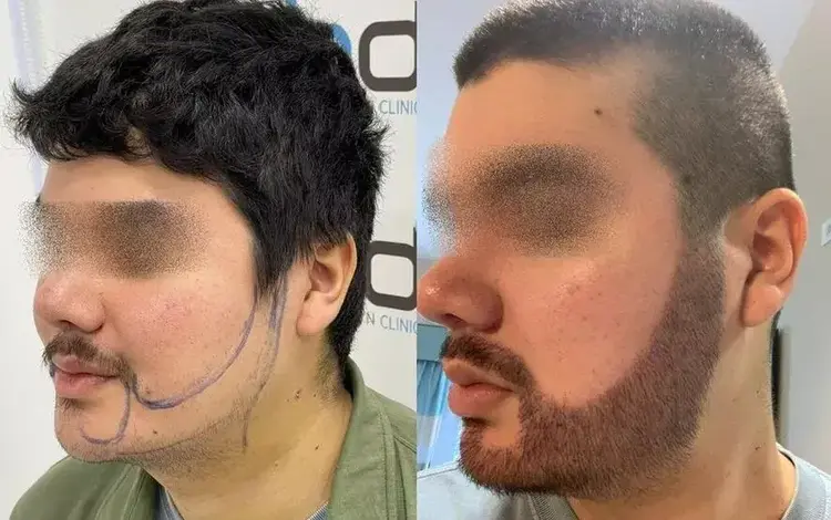 سقطت القشور بعد عشرَة أيام من زراعة اللحية.