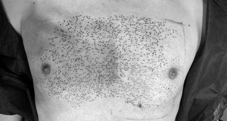 تجربة زراعة الشعر من الجسم