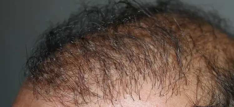 نسبة فشل زراعة الشعر