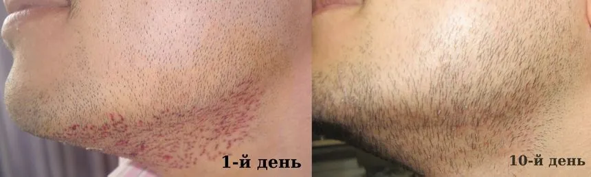 Через 10 дней на участке, откуда были взяты фолликулы для бороды, будет наблюдаться однородное и естественное изображение.
