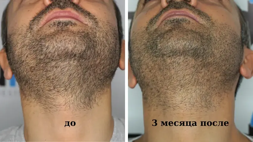 Через 3 месяца после пересадки волос на голову: Вид донорской области бороды.