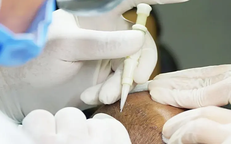 زراعة الشعر في تركيا dhi