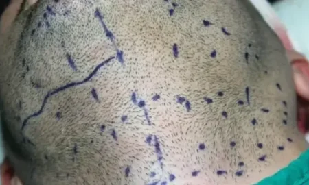 زراعة الشعر من اللحية إلى الرأس