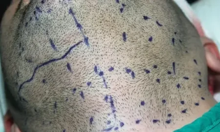 Bart-zu-Kopfhaar-Transplantation
