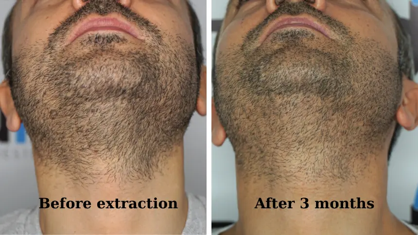 Facial image before beard graft harvesting and 3 months later. No scar.