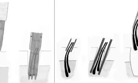FUE-Haartransplantation