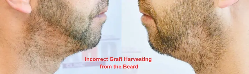 The poor appearance resulting from incorrect graft harvesting from the beard.